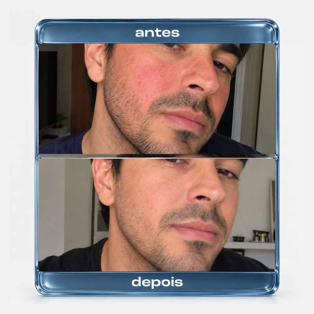 Protocolo HidraRepair Calmante - Rosácea, Dermatite, Pele sensível