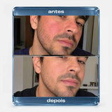 Protocolo HidraRepair Calmante - Rosácea, Dermatite, Pele sensível