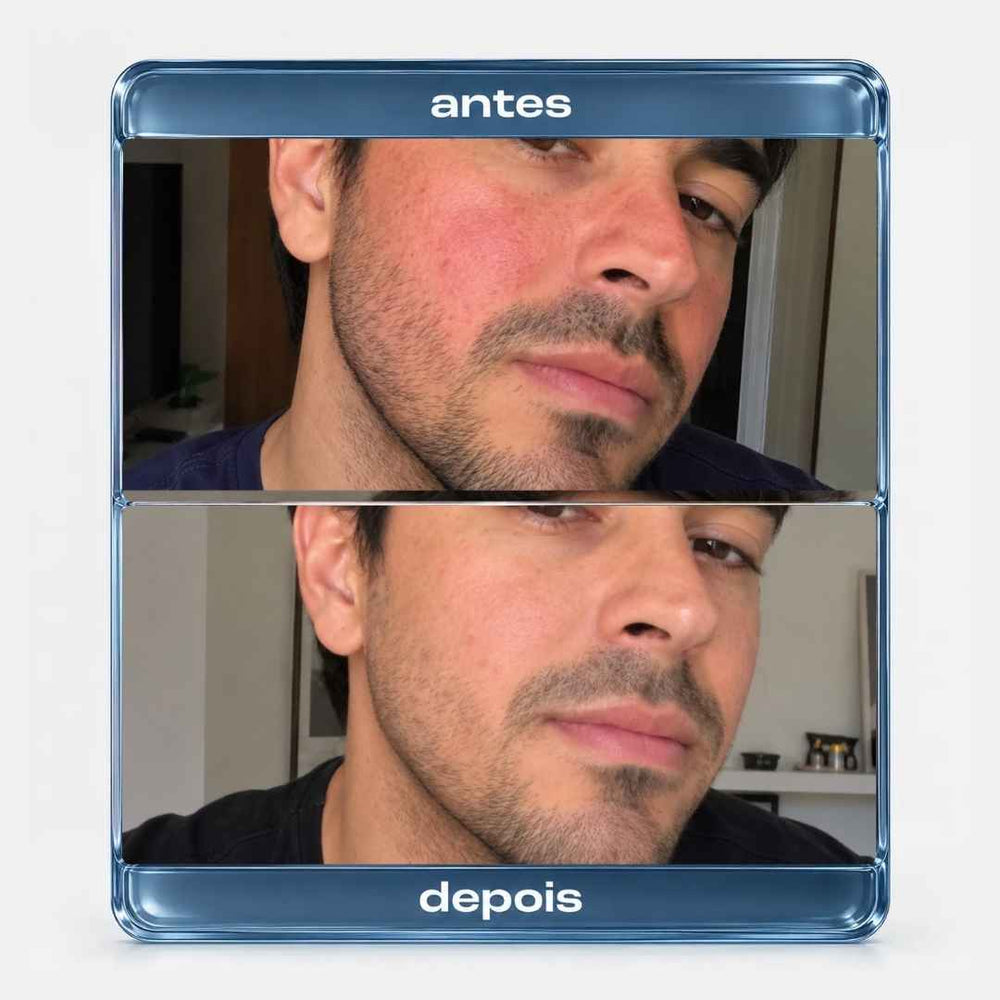Protocolo HidraRepair Calmante - Rosácea, Dermatite, Pele sensível